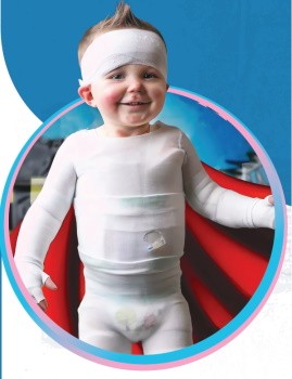 Бульозний епідермоліз